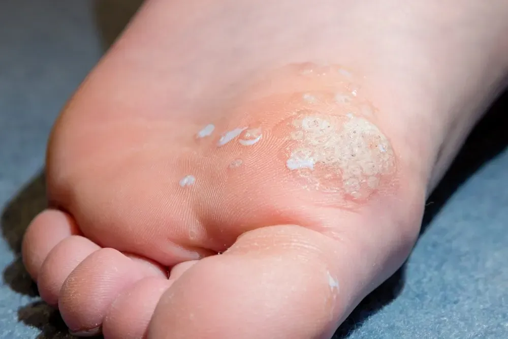 How Warts Removal Treatment Helps Clear Skin Fast?